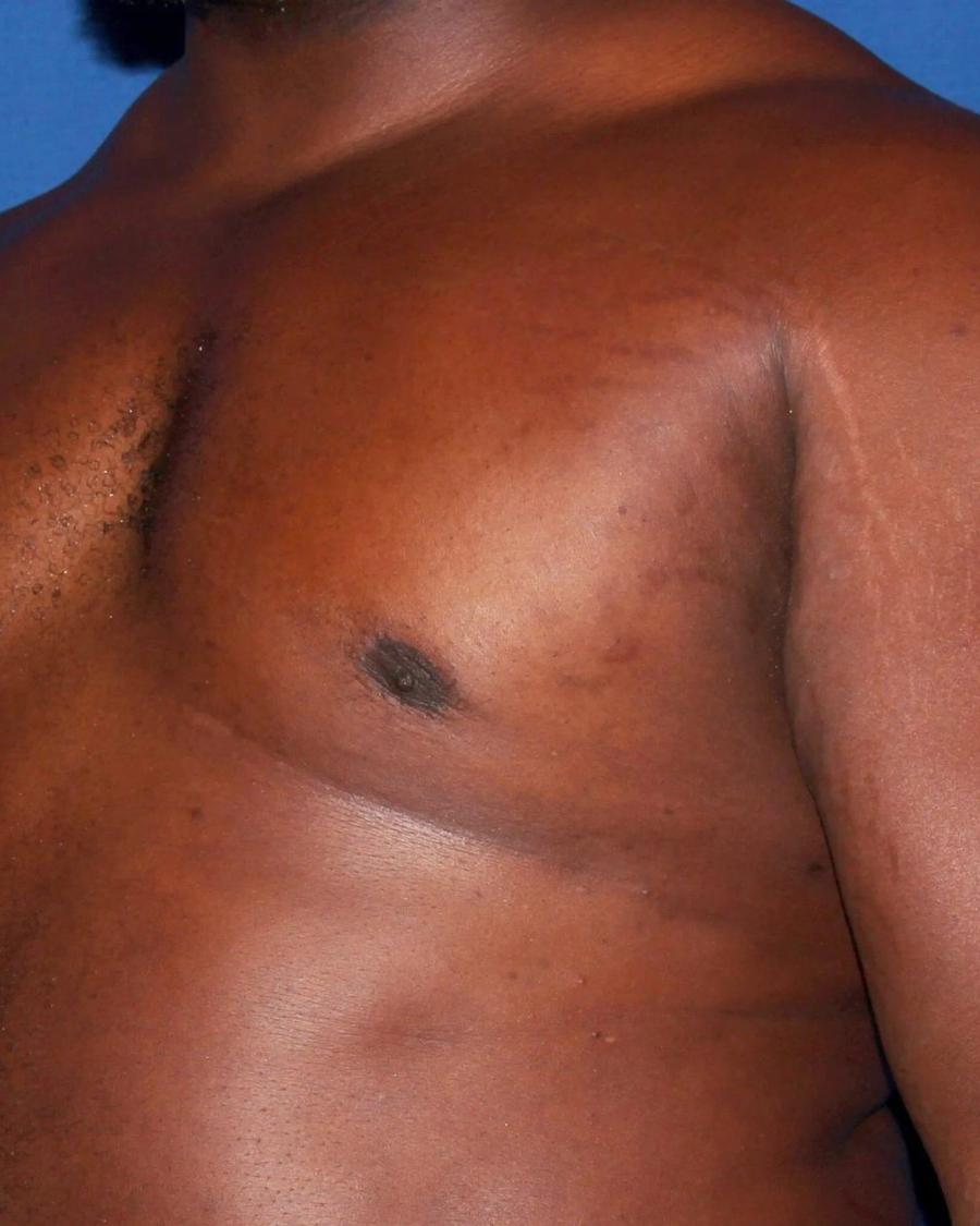 One-Stitch Gynecomastia after