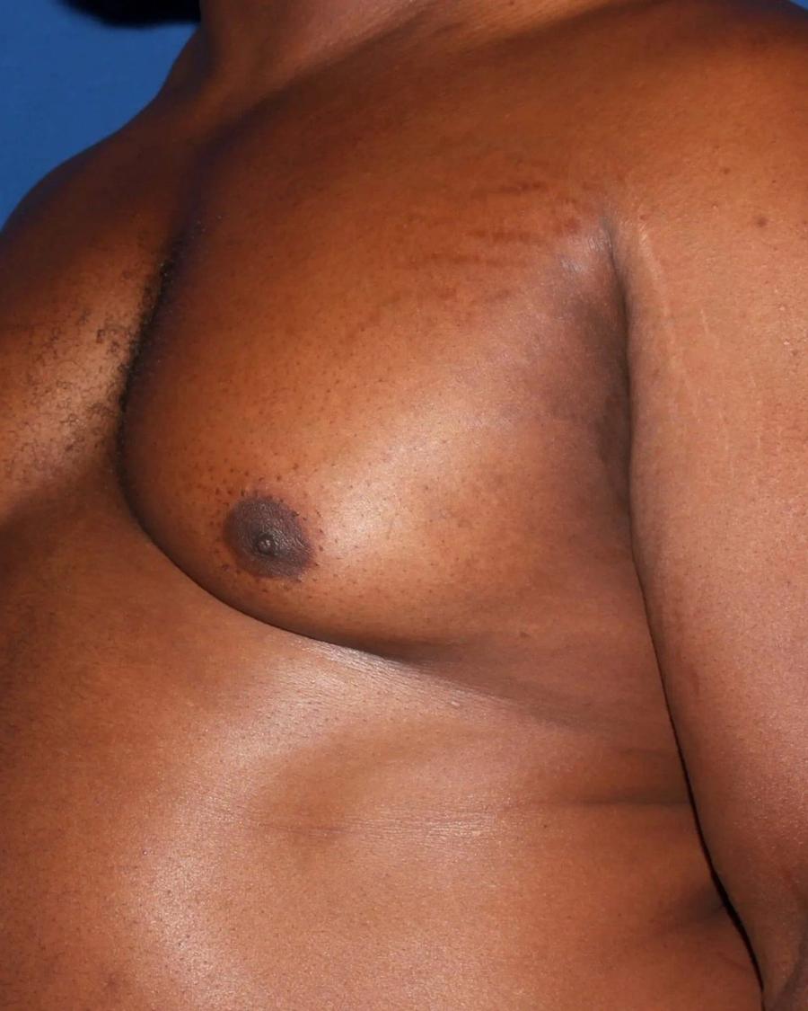 One-Stitch Gynecomastia before