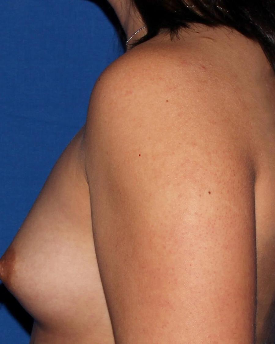 Breast Augmentation with Implants, Oblique Left view, before