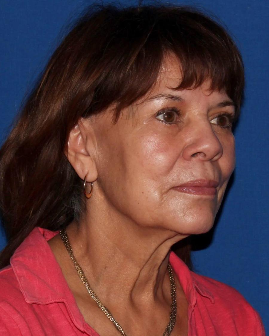 Facelift (neck lift included) before