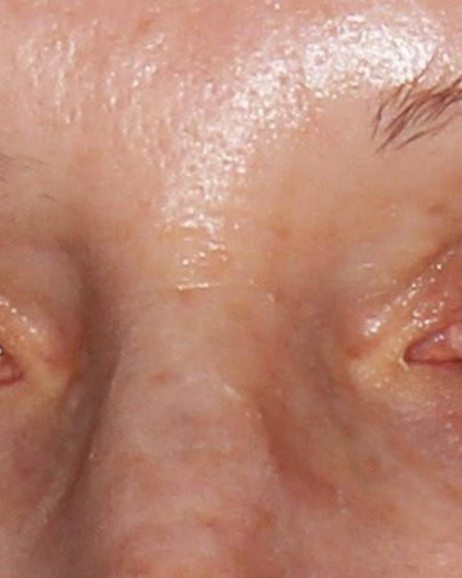 Eyelid Surgery after