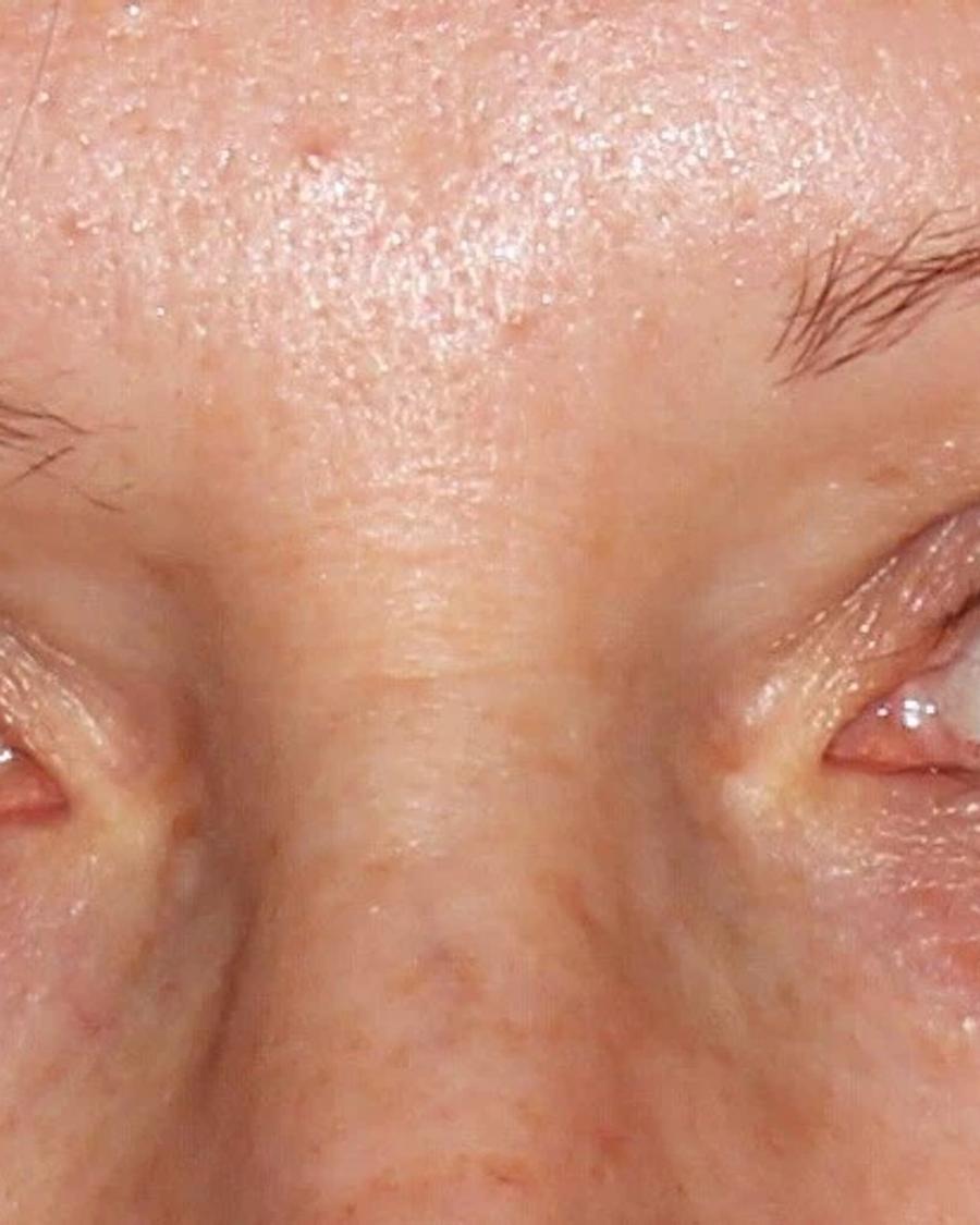 Eyelid Surgery before