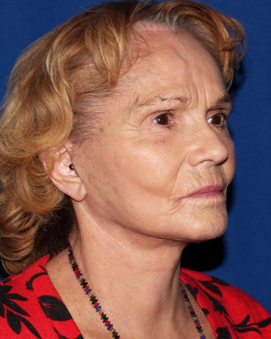 Facelift (neck lift included) after