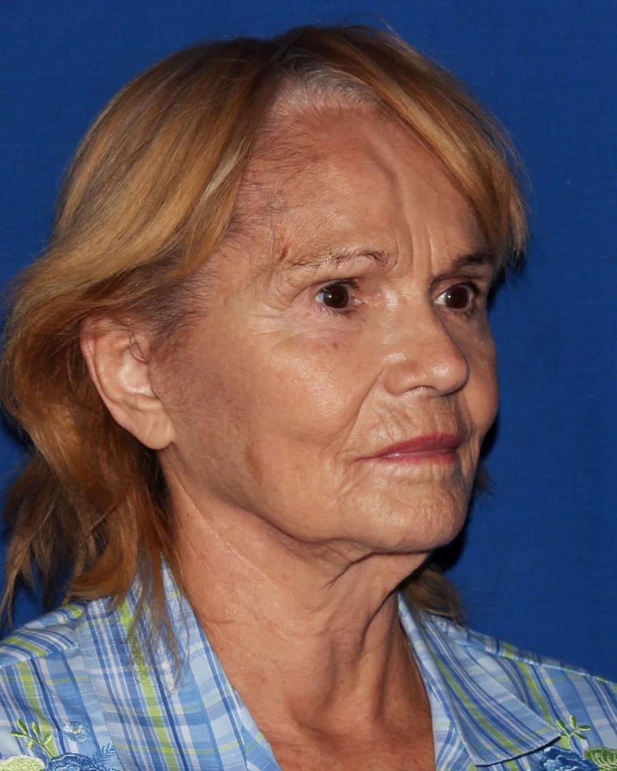 Facelift (neck lift included) before