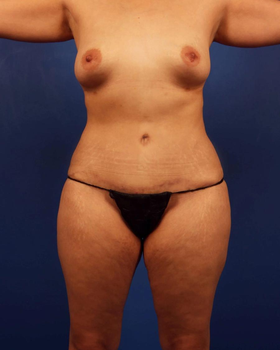 Tummy Tuck after