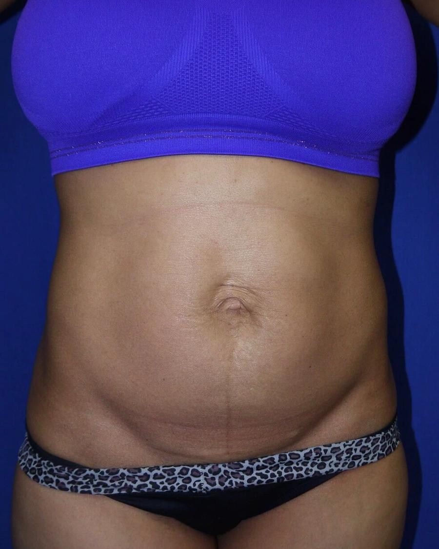 Tummy Tuck before