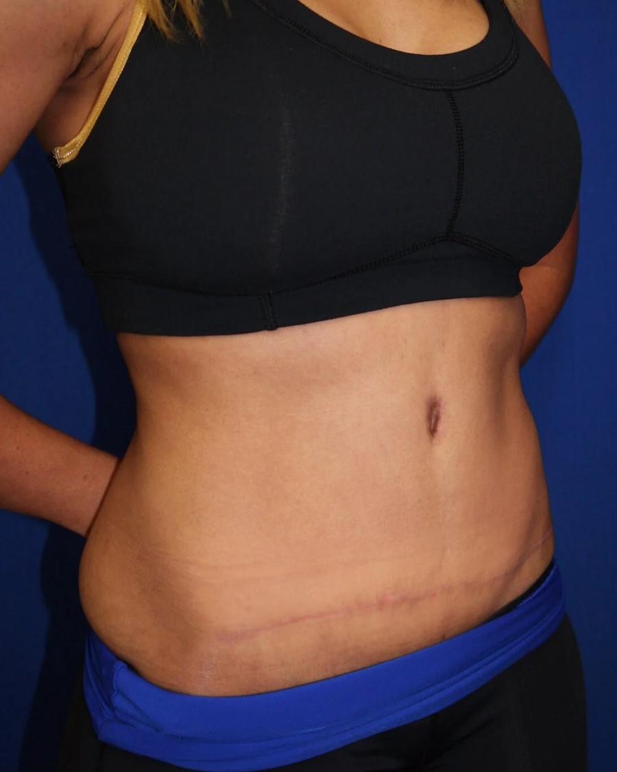 Tummy Tuck, Oblique Right view, after