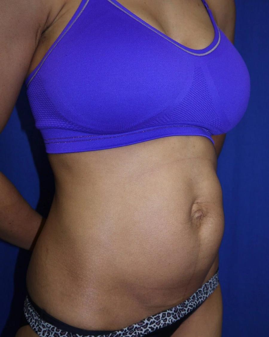 Tummy Tuck, Oblique Right view, before