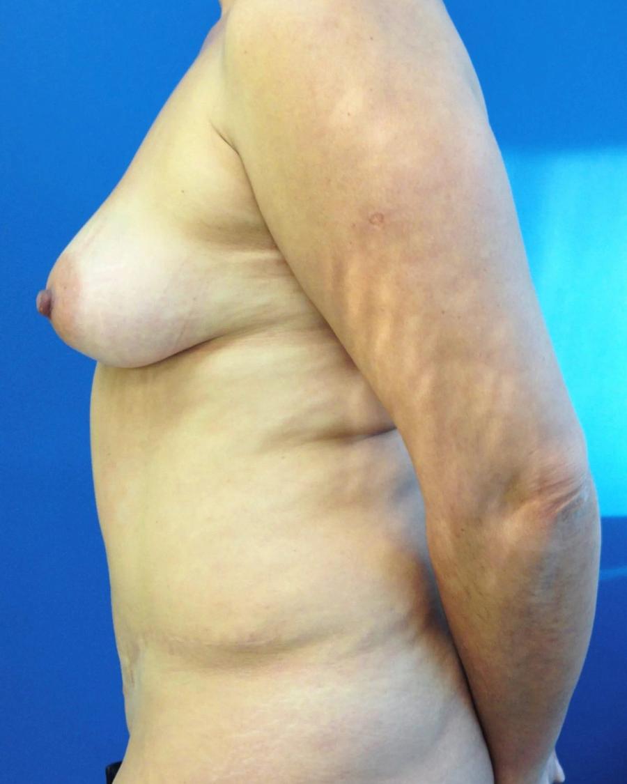 Tummy Tuck, Oblique Left view, before