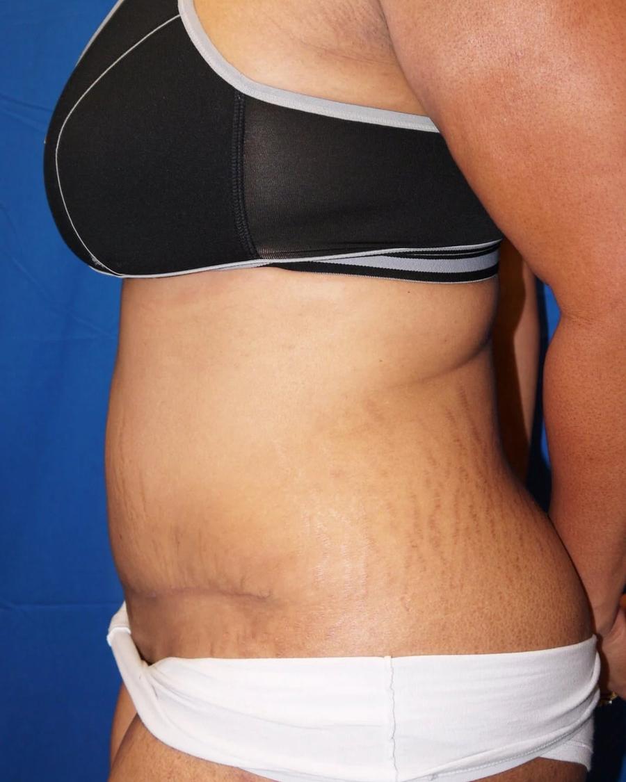 Tummy Tuck, Oblique Right view, after