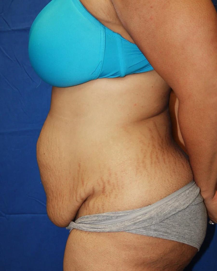 Tummy Tuck, Oblique Right view, before