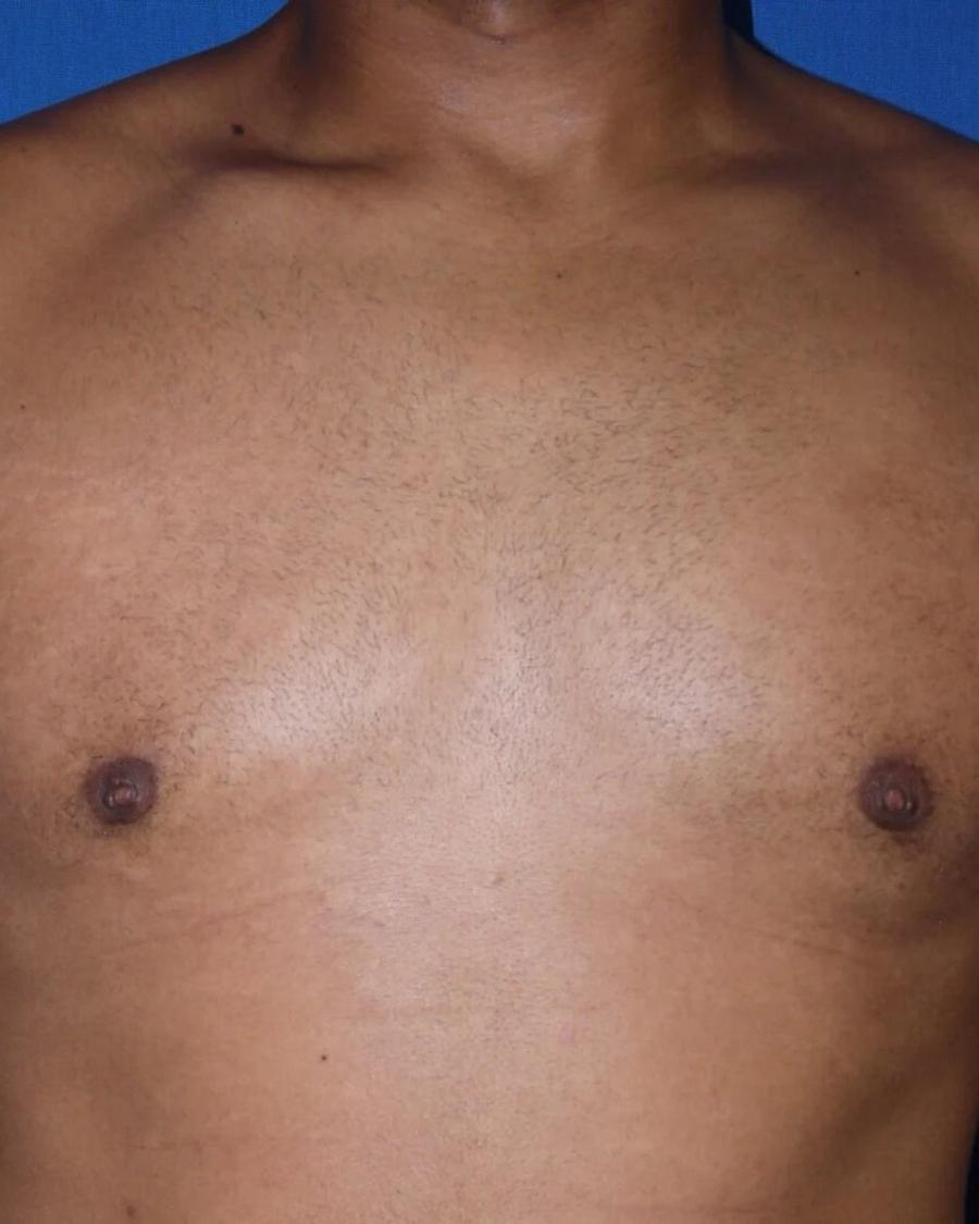 One-Stitch Gynecomastia after