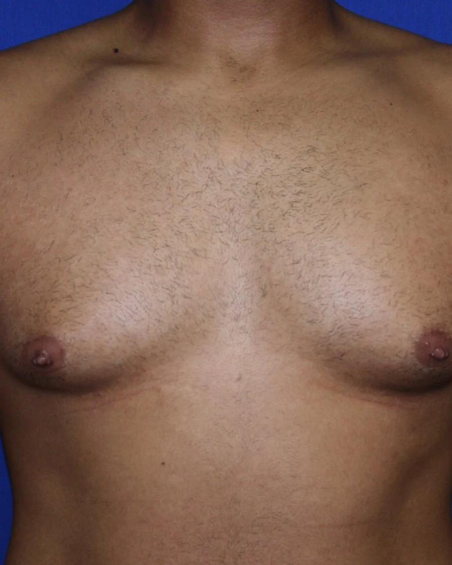 One-Stitch Gynecomastia before
