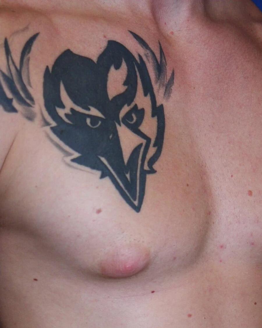 One-Stitch Gynecomastia before