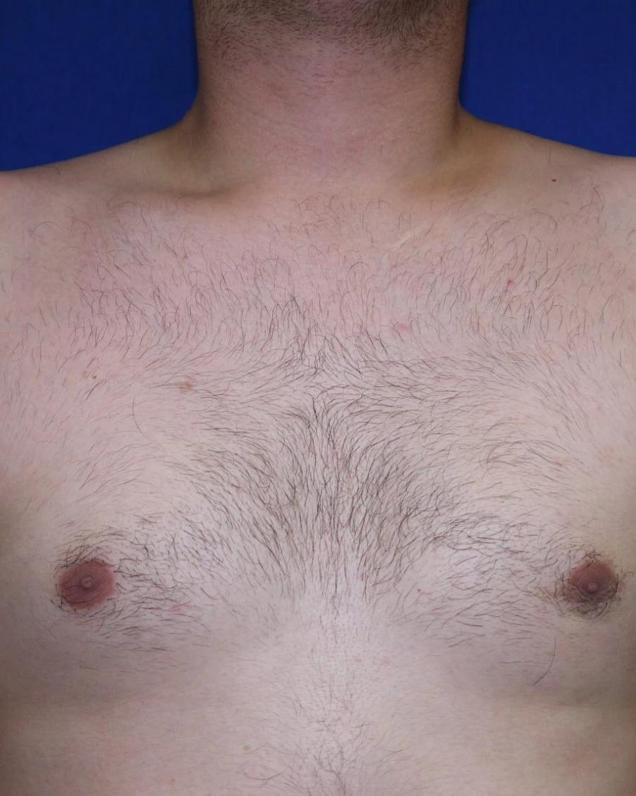 One-Stitch Gynecomastia after