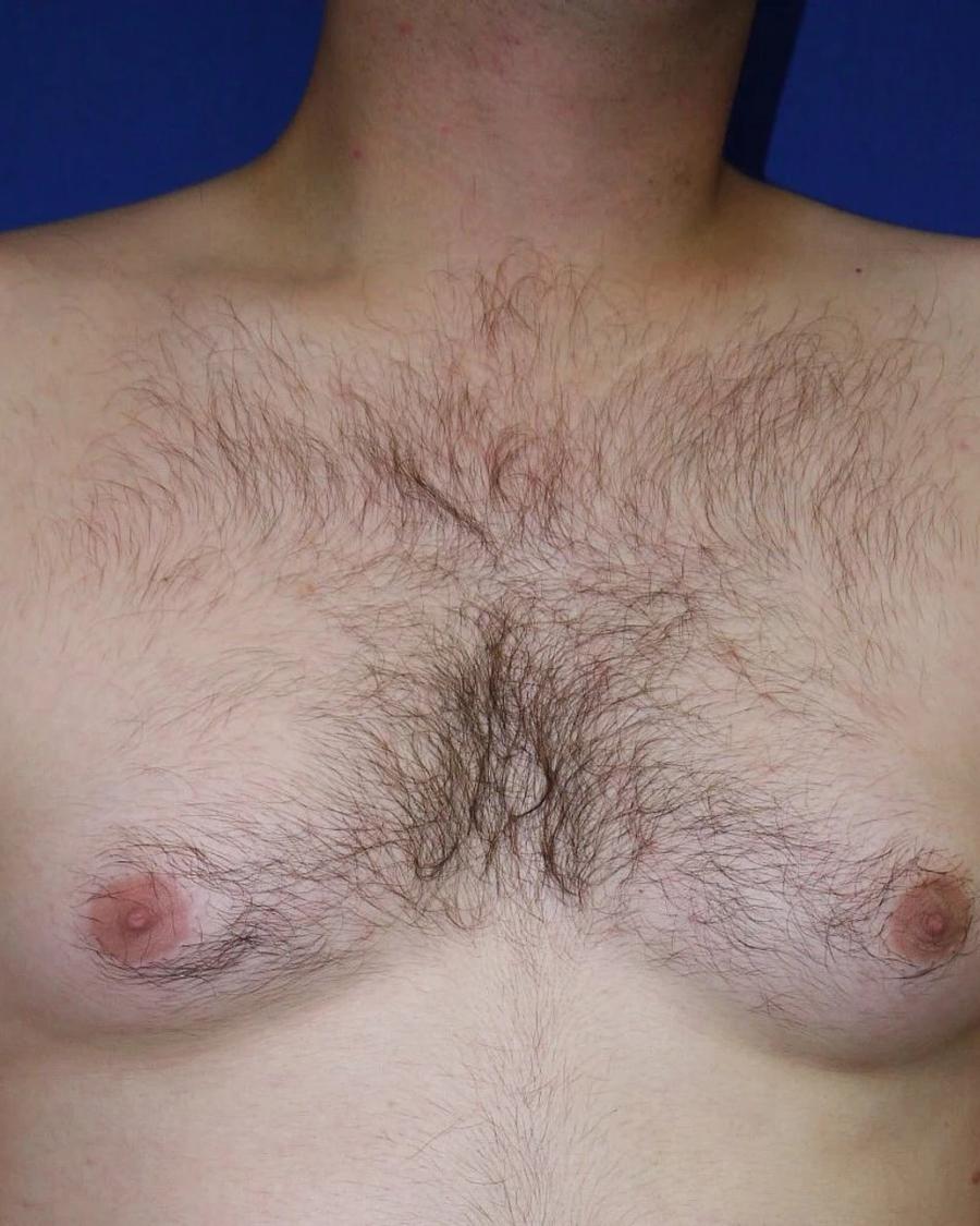 One-Stitch Gynecomastia before