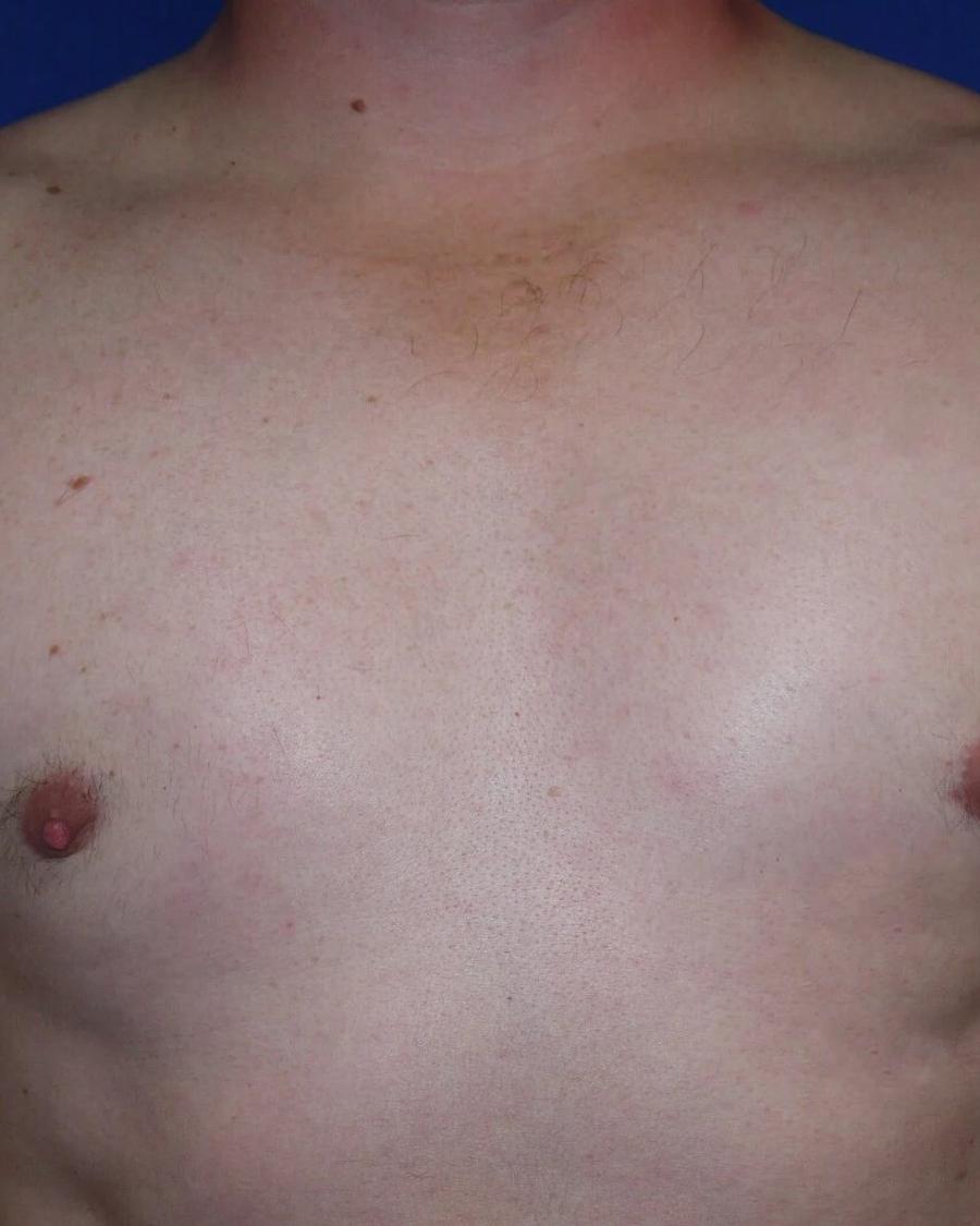 One-Stitch Gynecomastia after