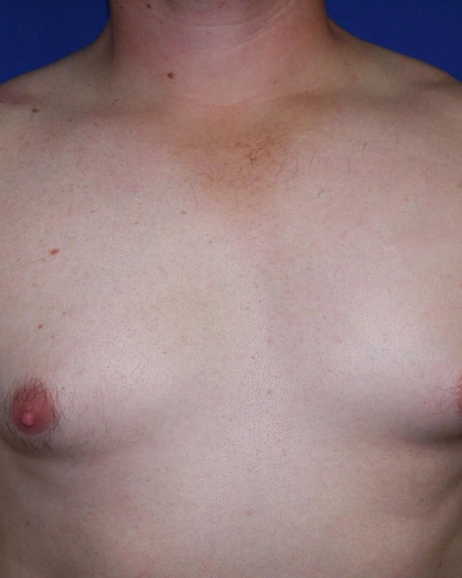 One-Stitch Gynecomastia before