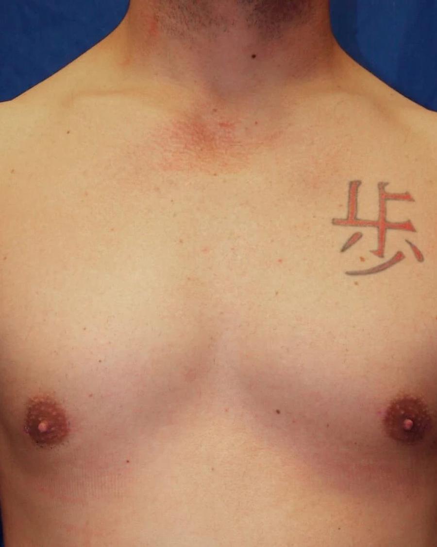 One-Stitch Gynecomastia after