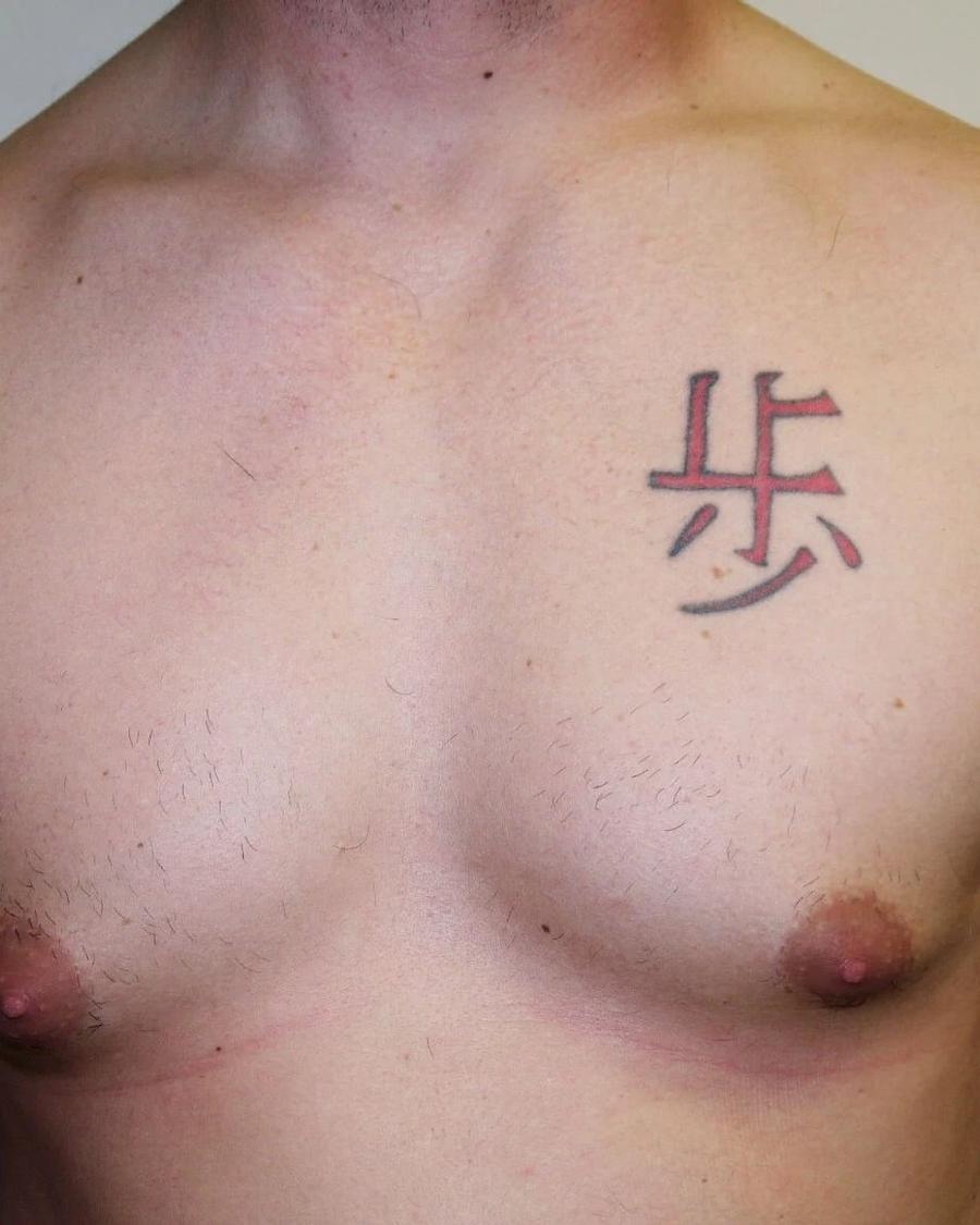One-Stitch Gynecomastia before