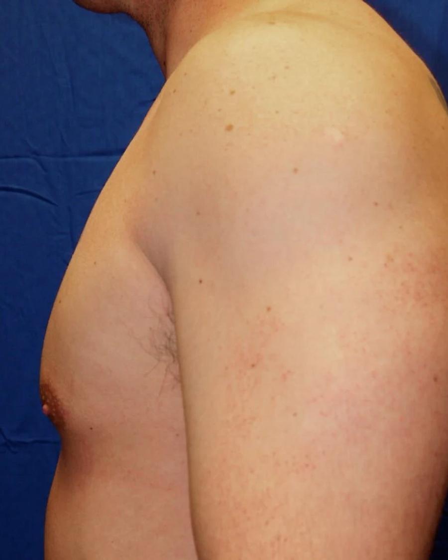 One-Stitch Gynecomastia, Oblique Left view, after