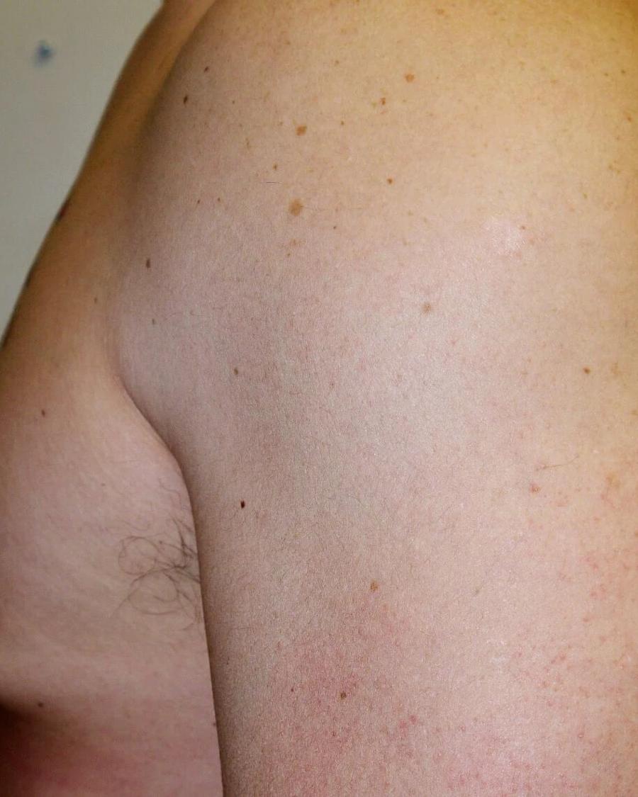 One-Stitch Gynecomastia, Oblique Left view, before