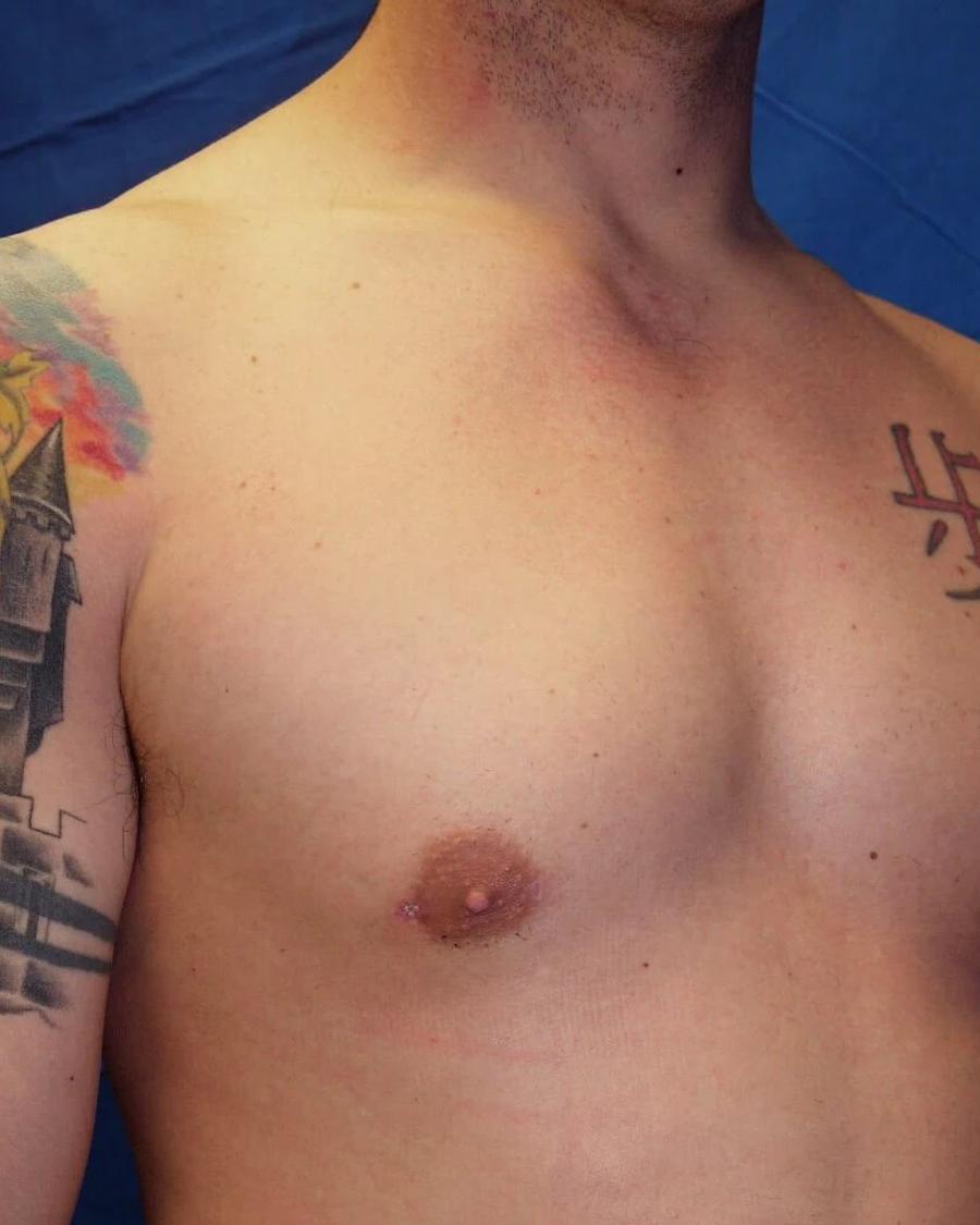 One-Stitch Gynecomastia after