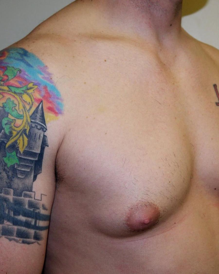 One-Stitch Gynecomastia before