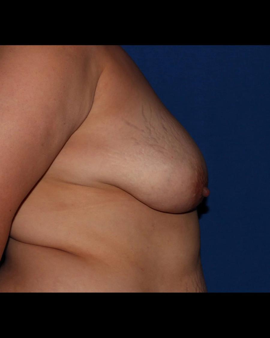 Fat Transfer To the Breast, Right Profile view, before