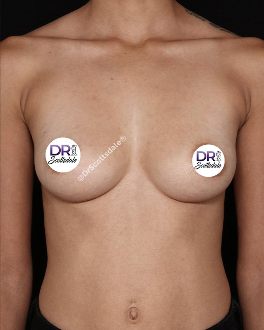 Breast Augmentation with Implants before