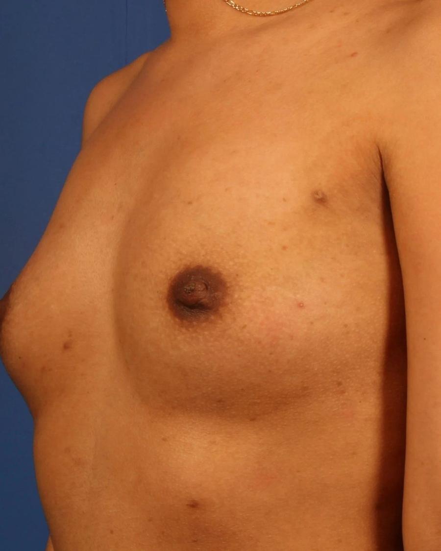 Breast Augmentation with Implants, Oblique Right view, before
