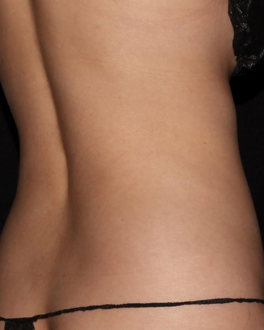 Vaser Lipo 360 (5L Max), Back view, before