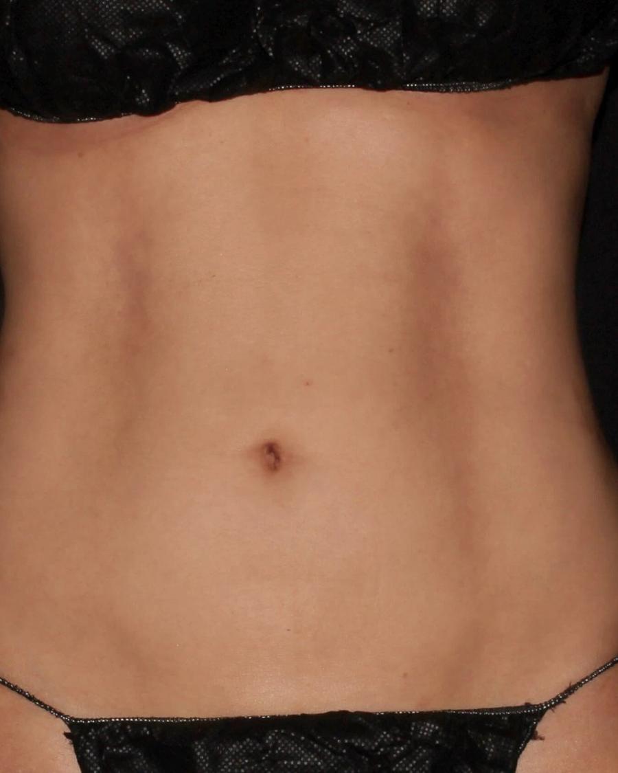 Vaser Lipo 360 (5L Max) after