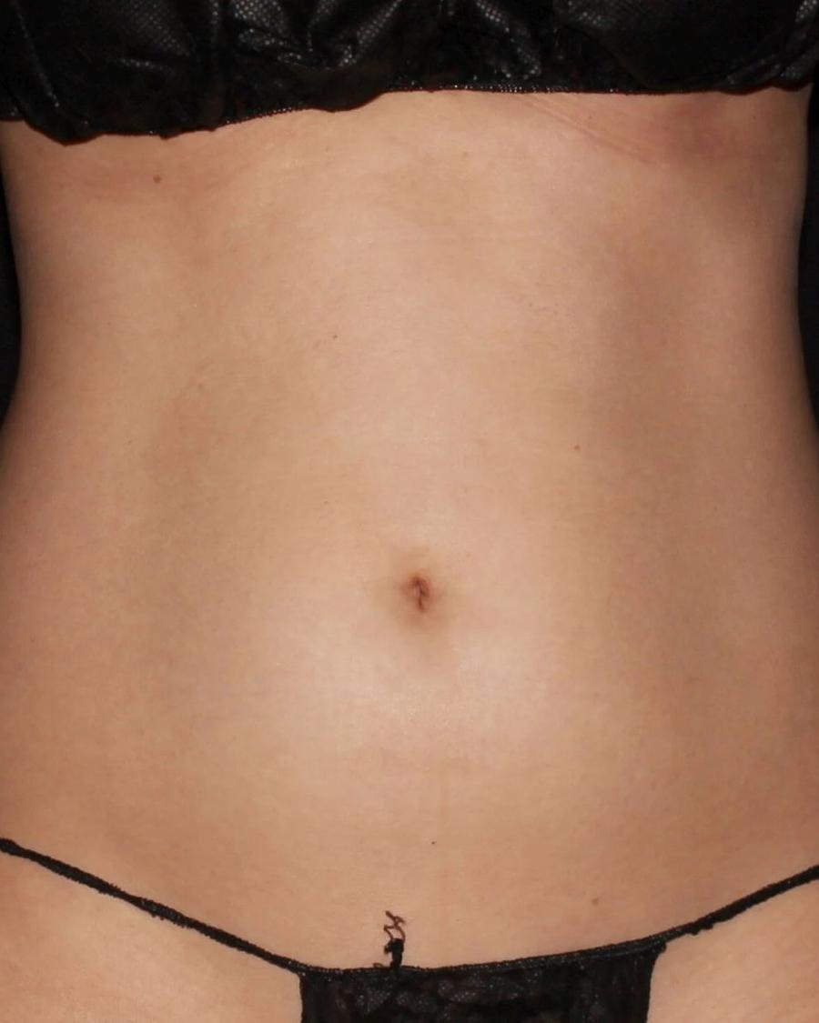 Vaser Lipo 360 (5L Max) before