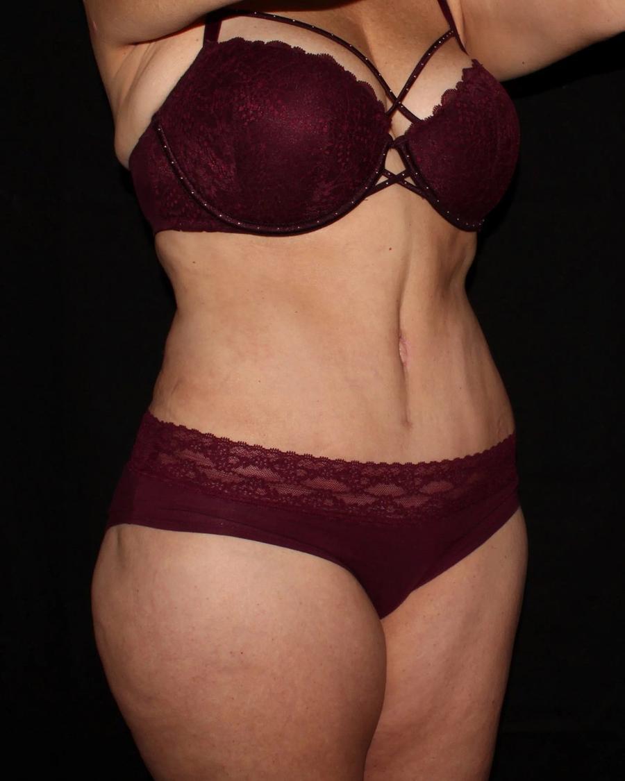 Tummy Tuck, Oblique Right view, after