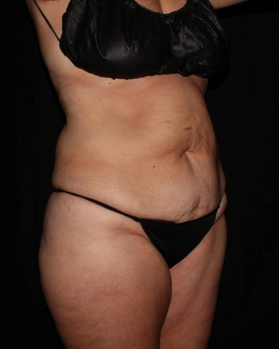 Tummy Tuck, Oblique Right view, before