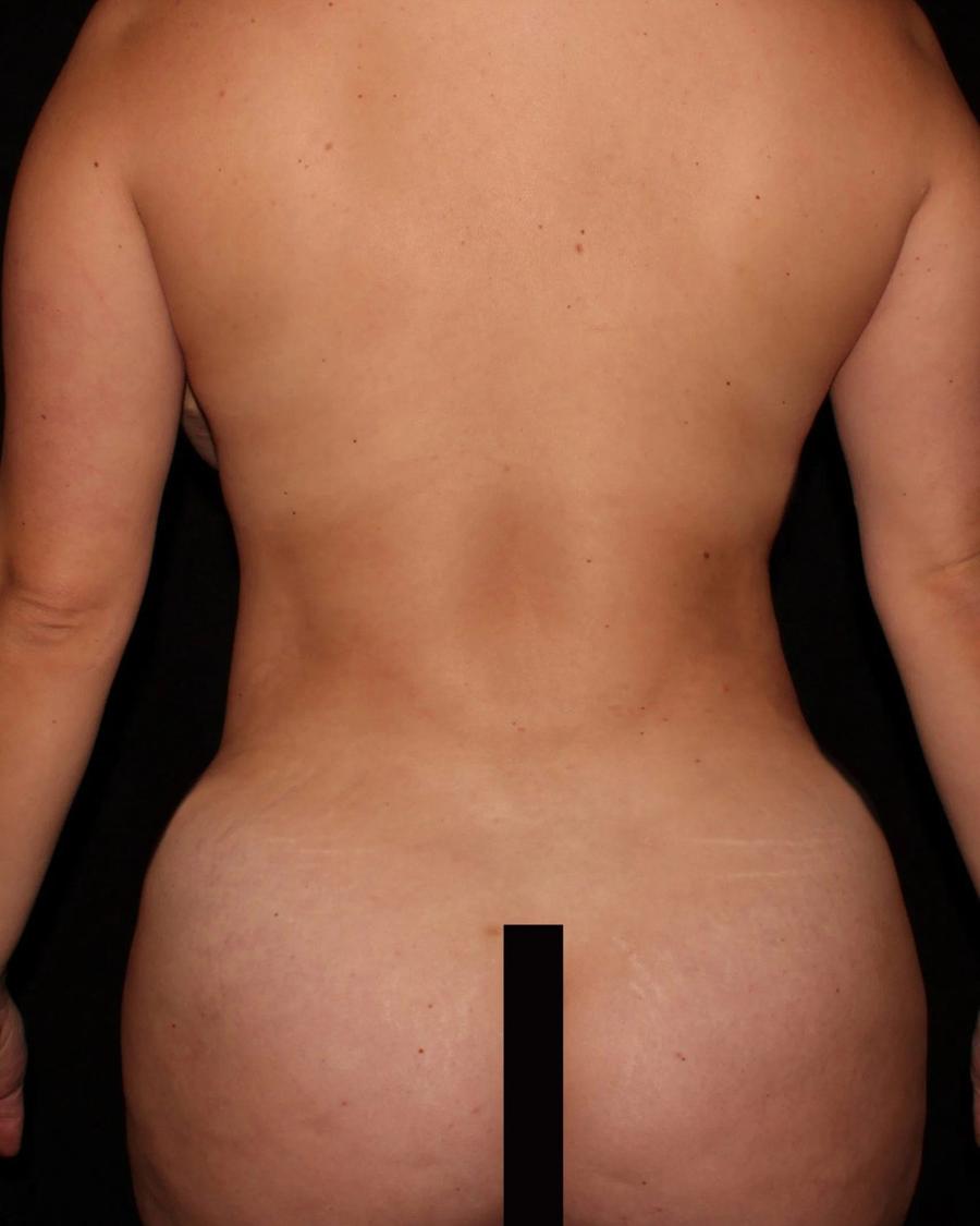 Mommy Makeover, Back view, after