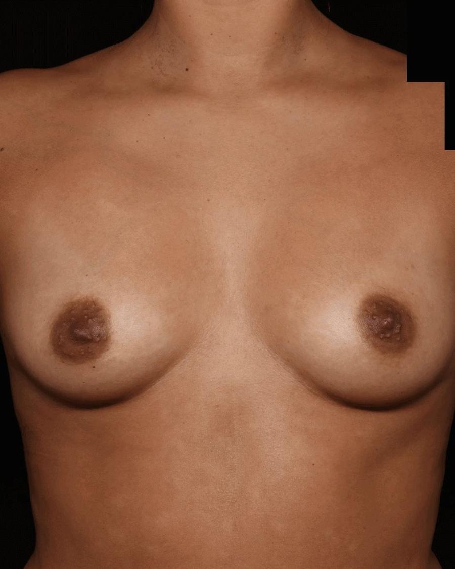 Breast Augmentation with Implants before