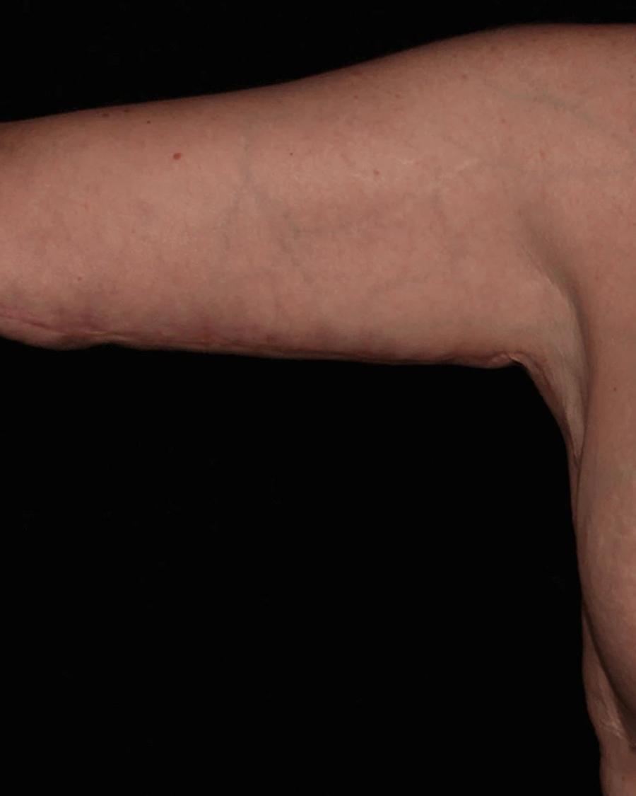 Arm Lift after