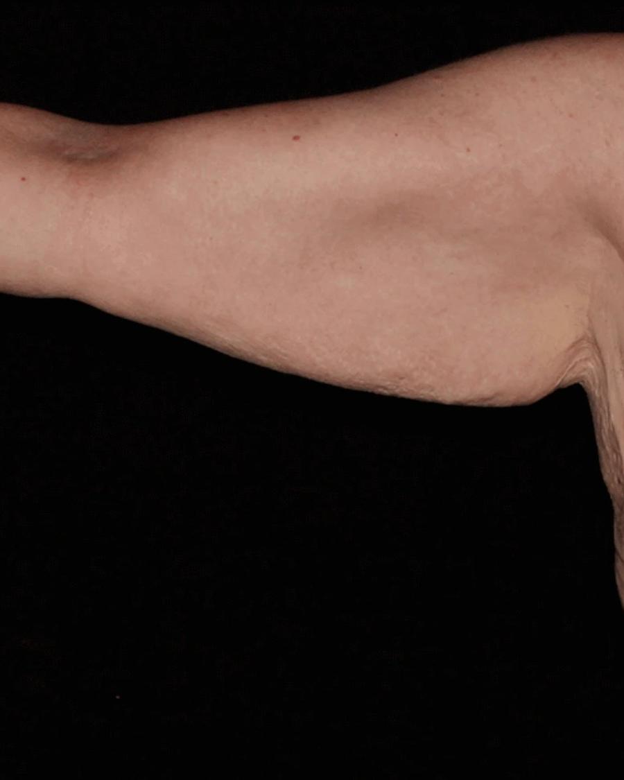 Arm Lift before