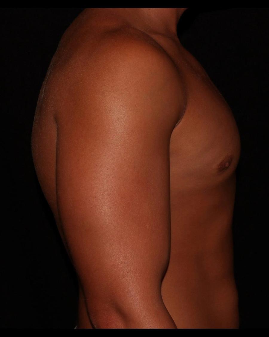 One-Stitch Gynecomastia, Right Profile view, after