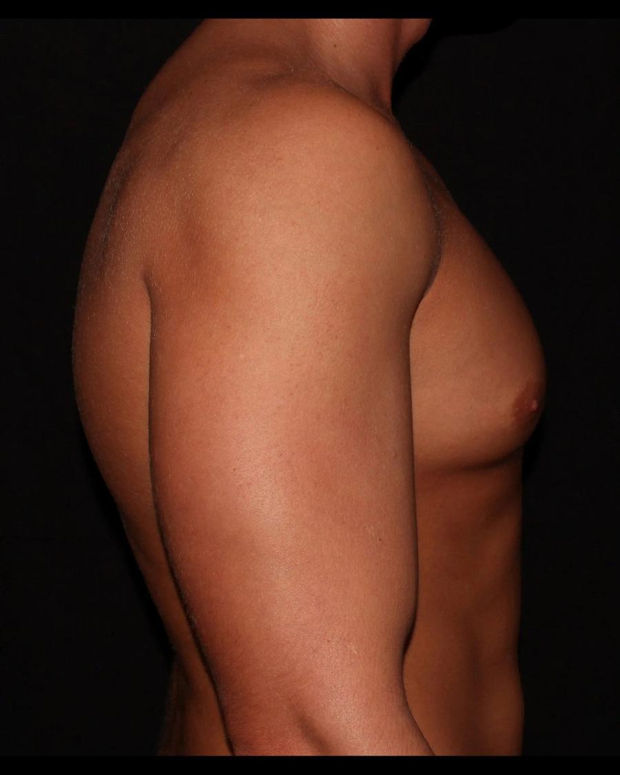 One-Stitch Gynecomastia, Right Profile view, before