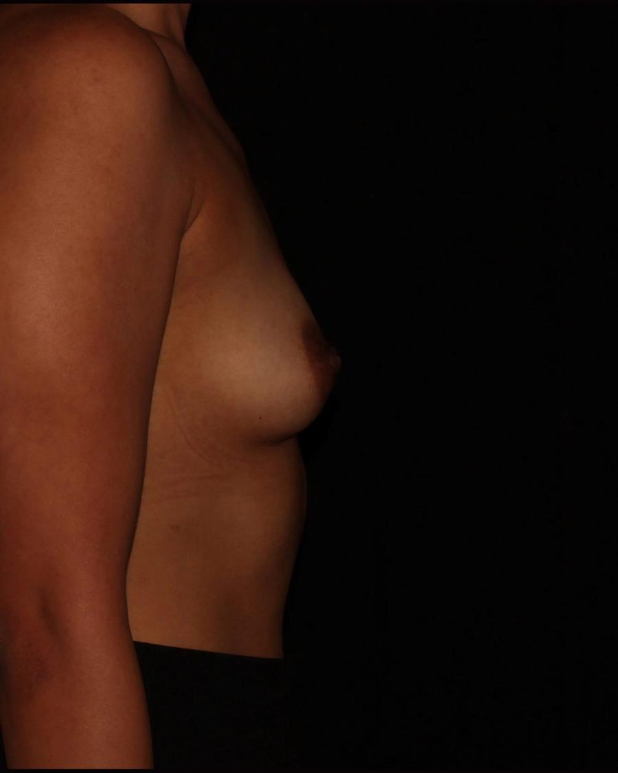 Breast Augmentation with Implants, Right Profile view, before