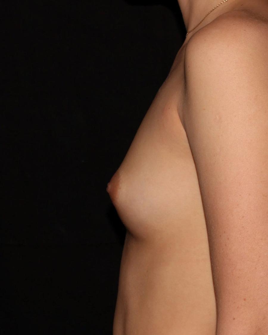 Breast Augmentation with Implants, Right Profile view, before