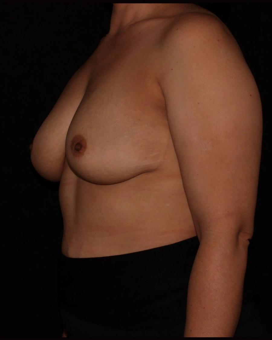 Breast Augmentation with Implants, Oblique Right view, before
