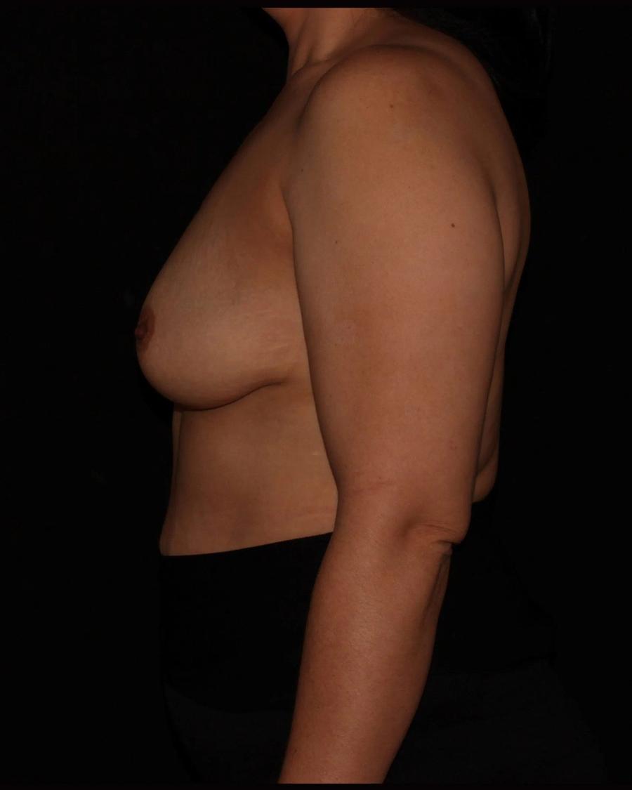 Breast Augmentation with Implants, Right Profile view, before