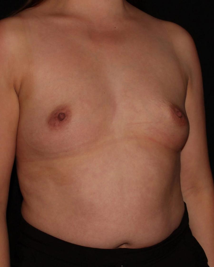 Breast Augmentation with Implants, Oblique Right view, before