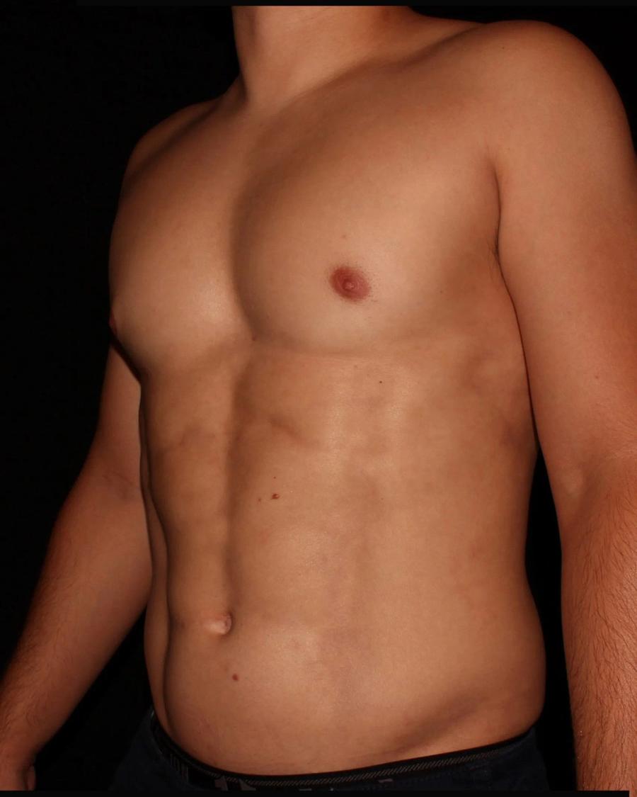 Vaser Lipo 360 (5L Max), Oblique Right view, after