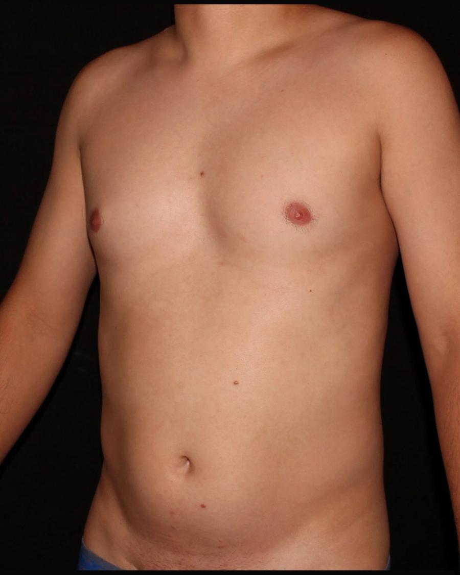 Vaser Lipo 360 (5L Max), Oblique Right view, before