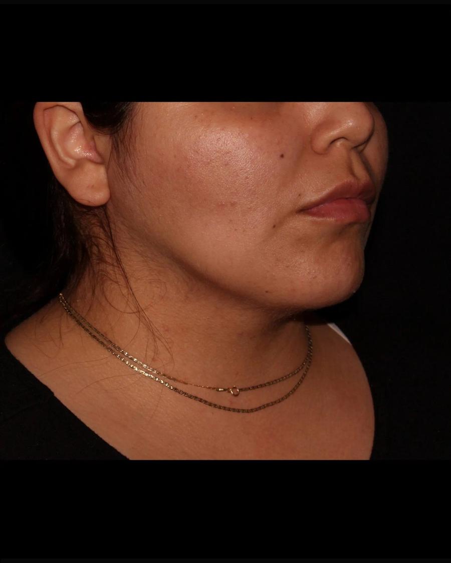 Buccal Fat Pad Removal, Oblique Right view, after